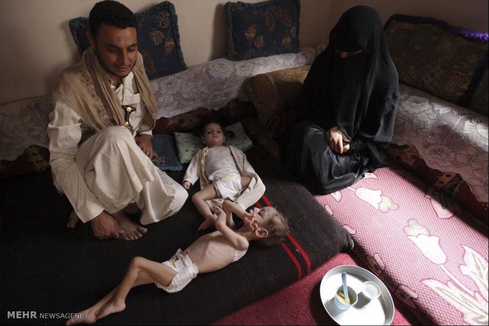 گرسنگی در یمن