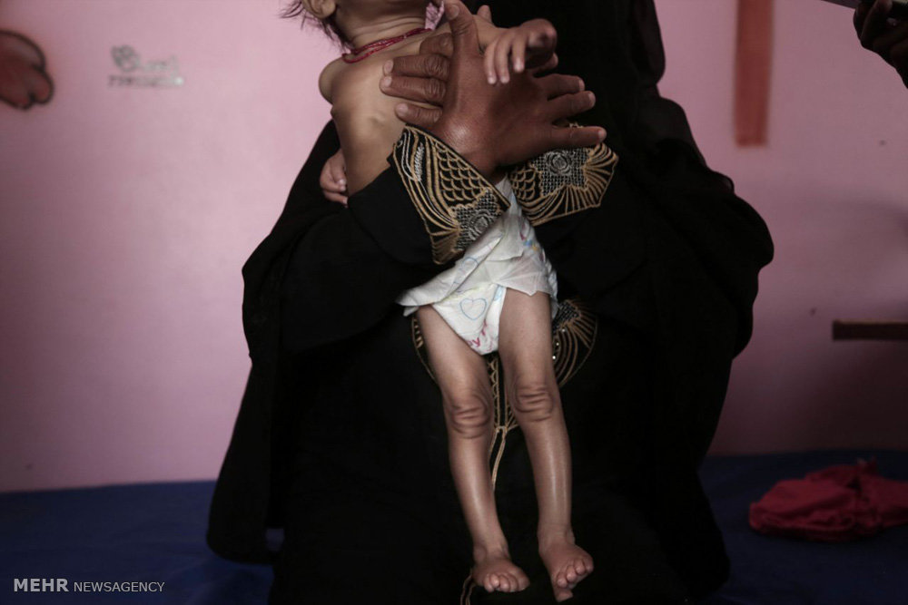 گرسنگی در یمن‎
