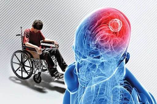 این تغییر در چشمها نشانه «ام اس» است